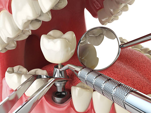 Best Emergency Root Canal Treatment in Dumbarton, VA